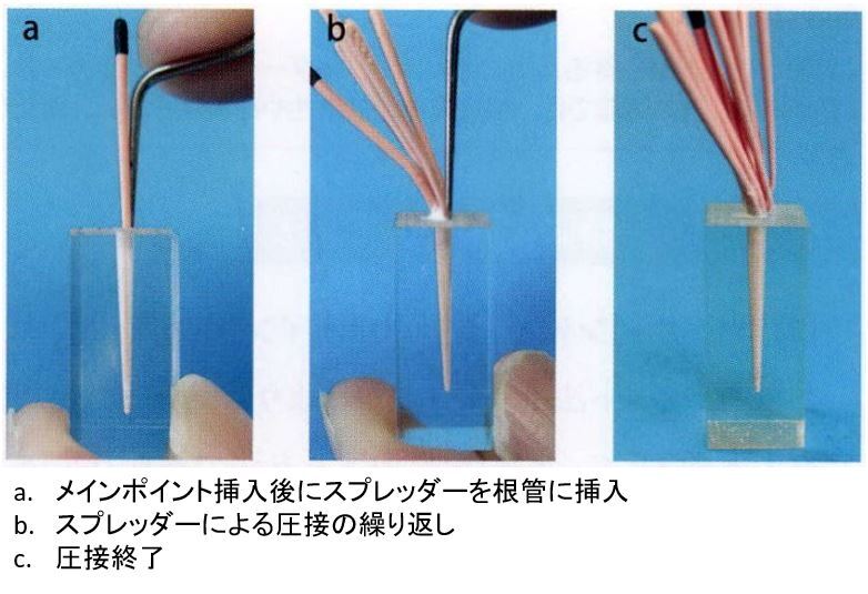 根管充填（側方加圧根管充填）について